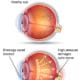 Glaucoma Eye Care Consultation Springfield Massachusetts