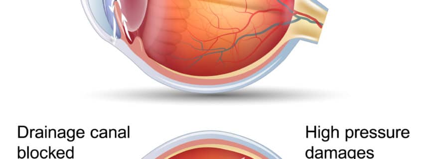 Glaucoma Eye Care Consultation Springfield Massachusetts