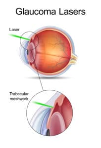 Glaucoma Lasers