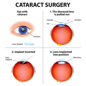 Cataract Surgery Springfield Massachusetts