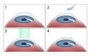 Lasik Eye Surgery Springfield Massachusetts