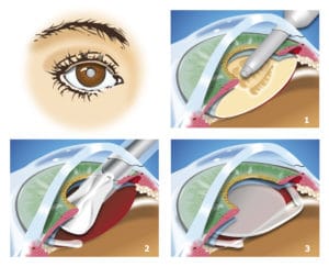 restore implant lens