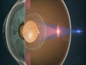 lens implants